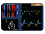 X-Strain Speckle Tracking базирана оценка на регионална и глобална функция на сърдечните кухини