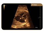 TP-View Трапецовидното разширение на зрителното поле при изследване на фетално сърце